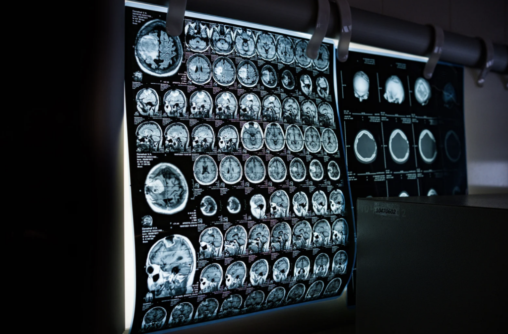 MRI Scan