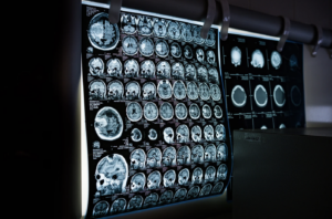 MRI Scan